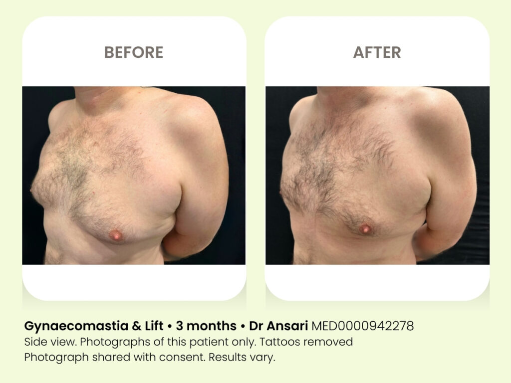 Chest surgery for men. Gynaecomastia cosmetic liposuction. Sydney.