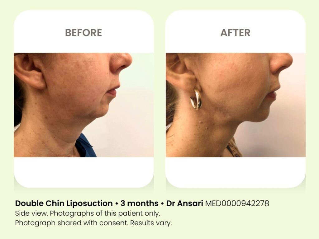 Before and after double chin liposuction at My Cosmetic Clinic, 3 months post-treatment.