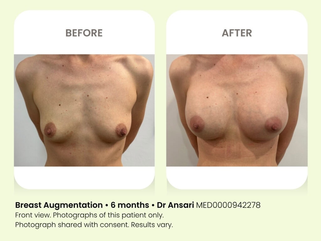 Breast augmentation before and after photos at My Cosmetic Clinic showing improved size and shape.