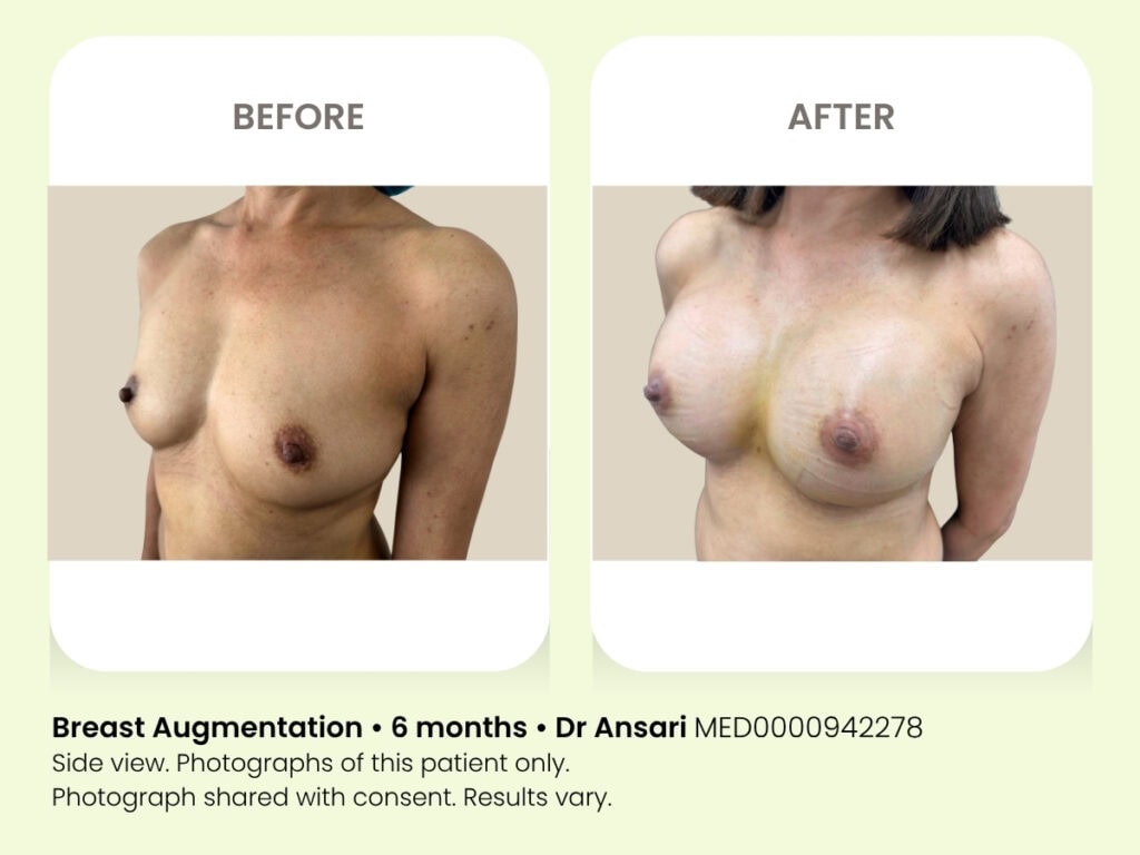 Breast augmentation results after 6 months at My Cosmetic Clinic.