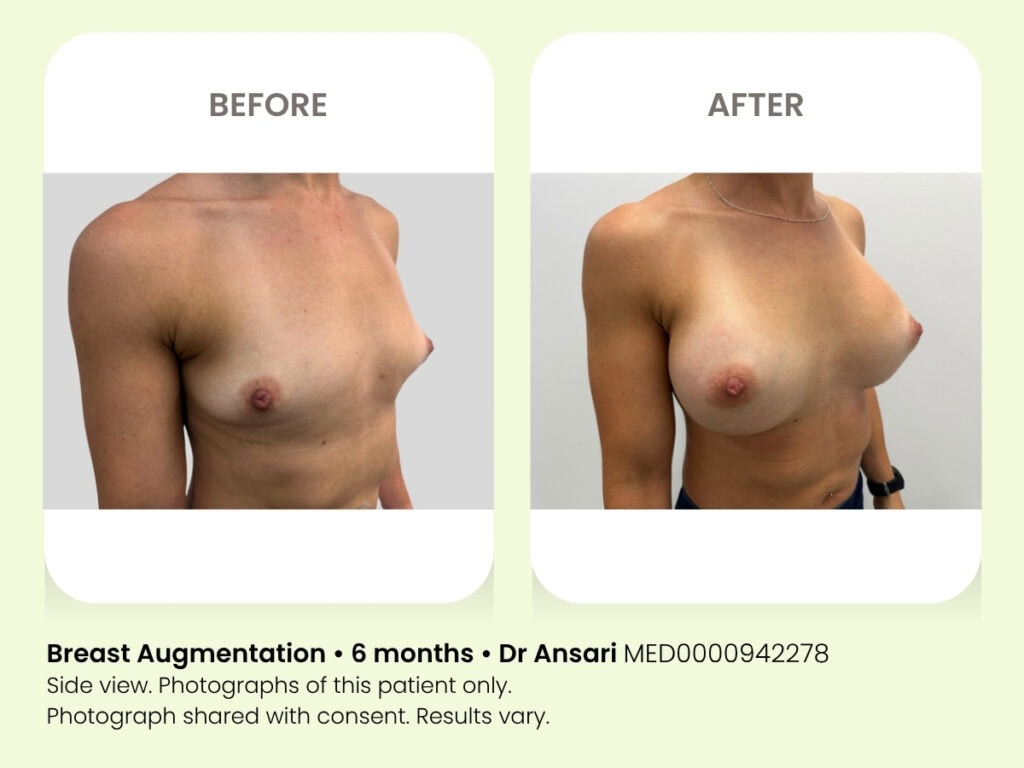 Breast augmentation before and after 6 months at My Cosmetic Clinic with Dr Ansari.