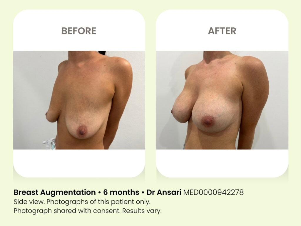 Breast augmentation before and after 6 months at My Cosmetic Clinic.