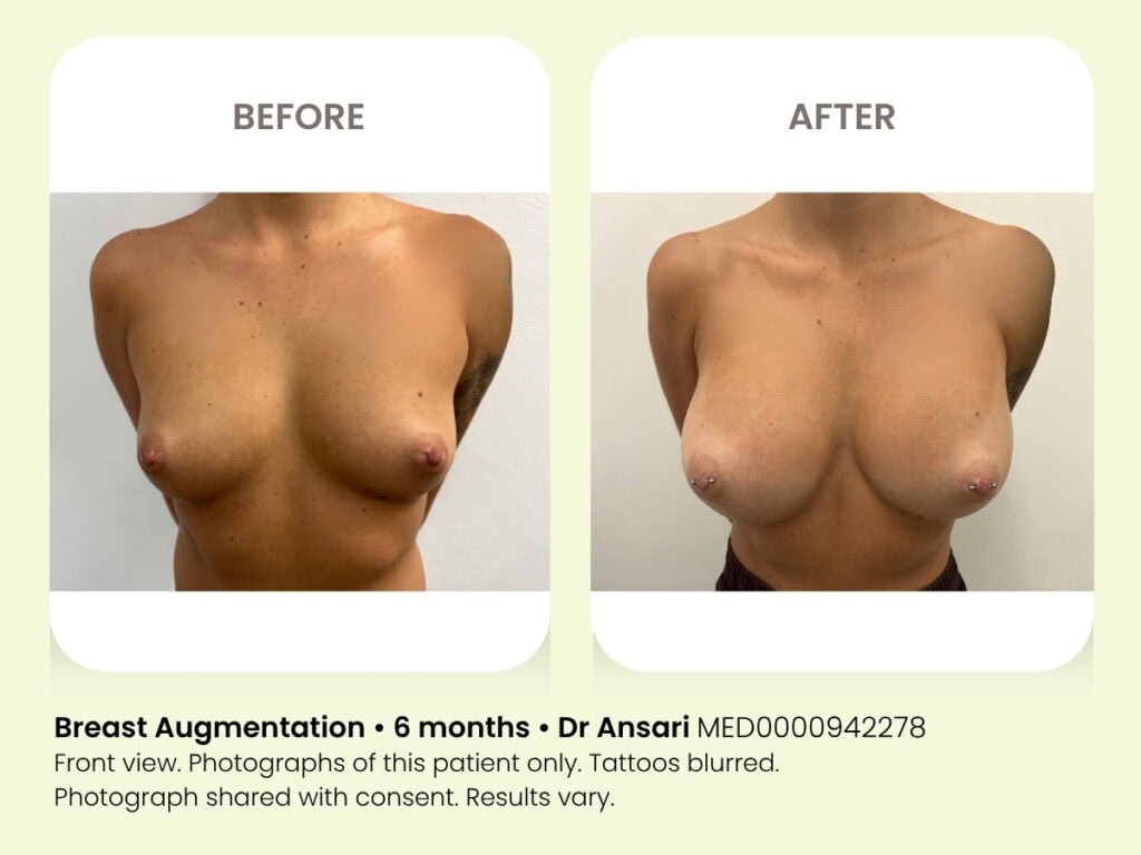 Breast augmentation before and after 6 months at My Cosmetic Clinic with Dr. Ansari.